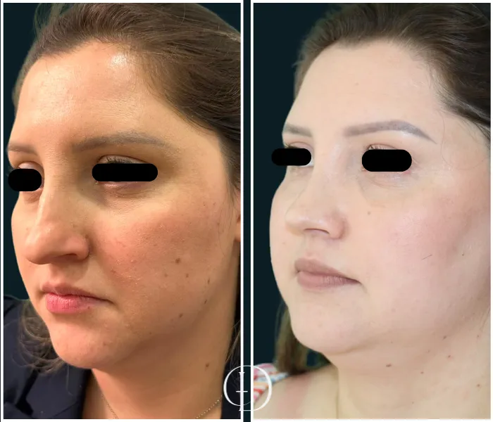 Pós Operatório de Rinoplastia Estruturada