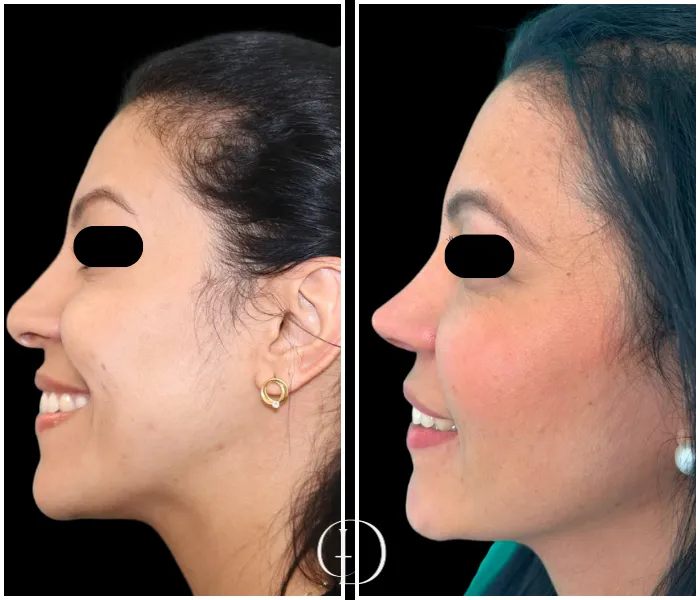 Pós Operatório de Rinoplastia Estruturada