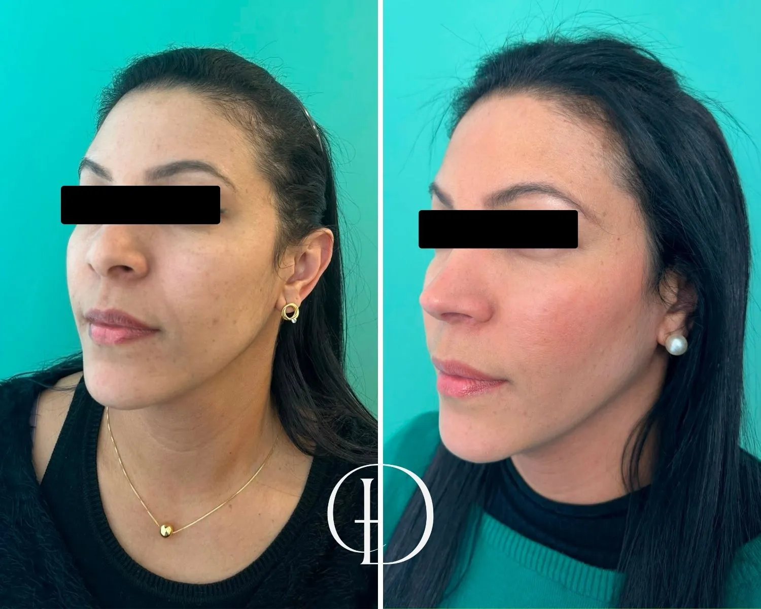 Pós Operatório de Rinoplastia Estruturada