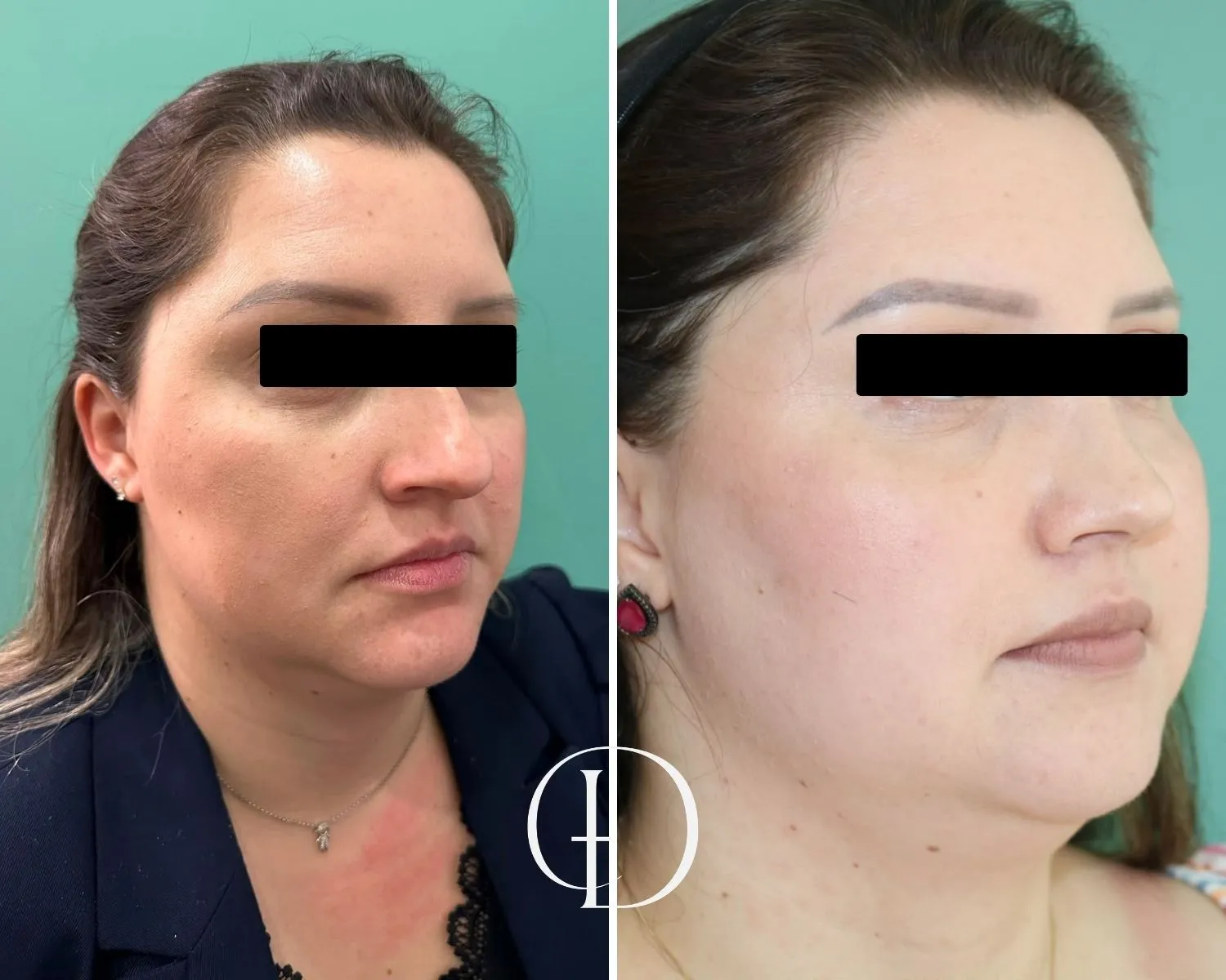 Pós Operatório de Rinoplastia Estruturada