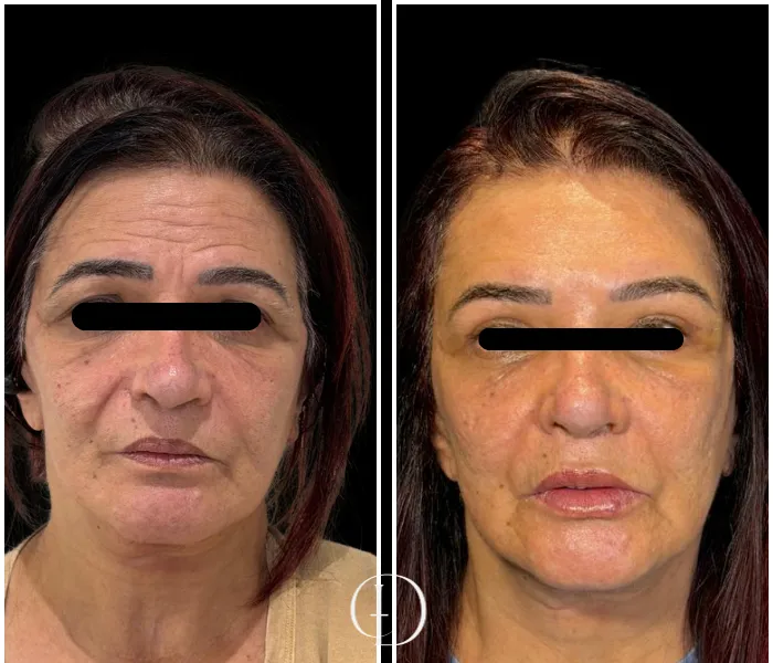 Pós operatório de Brown Lift Endoscopico e Blefaroplastia Superior