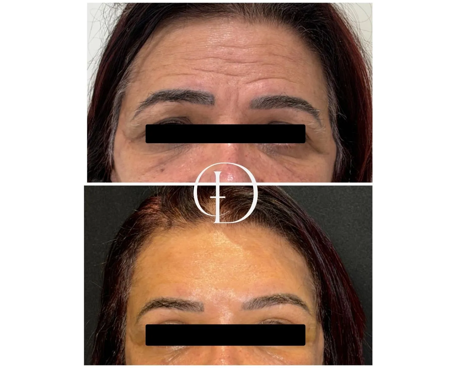 Pós operatório de Brown Lift Endoscopico e Blefaroplastia Superior