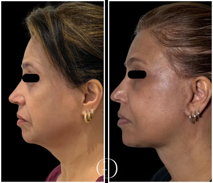 Pós operatório de facelift deep plane 1 ano