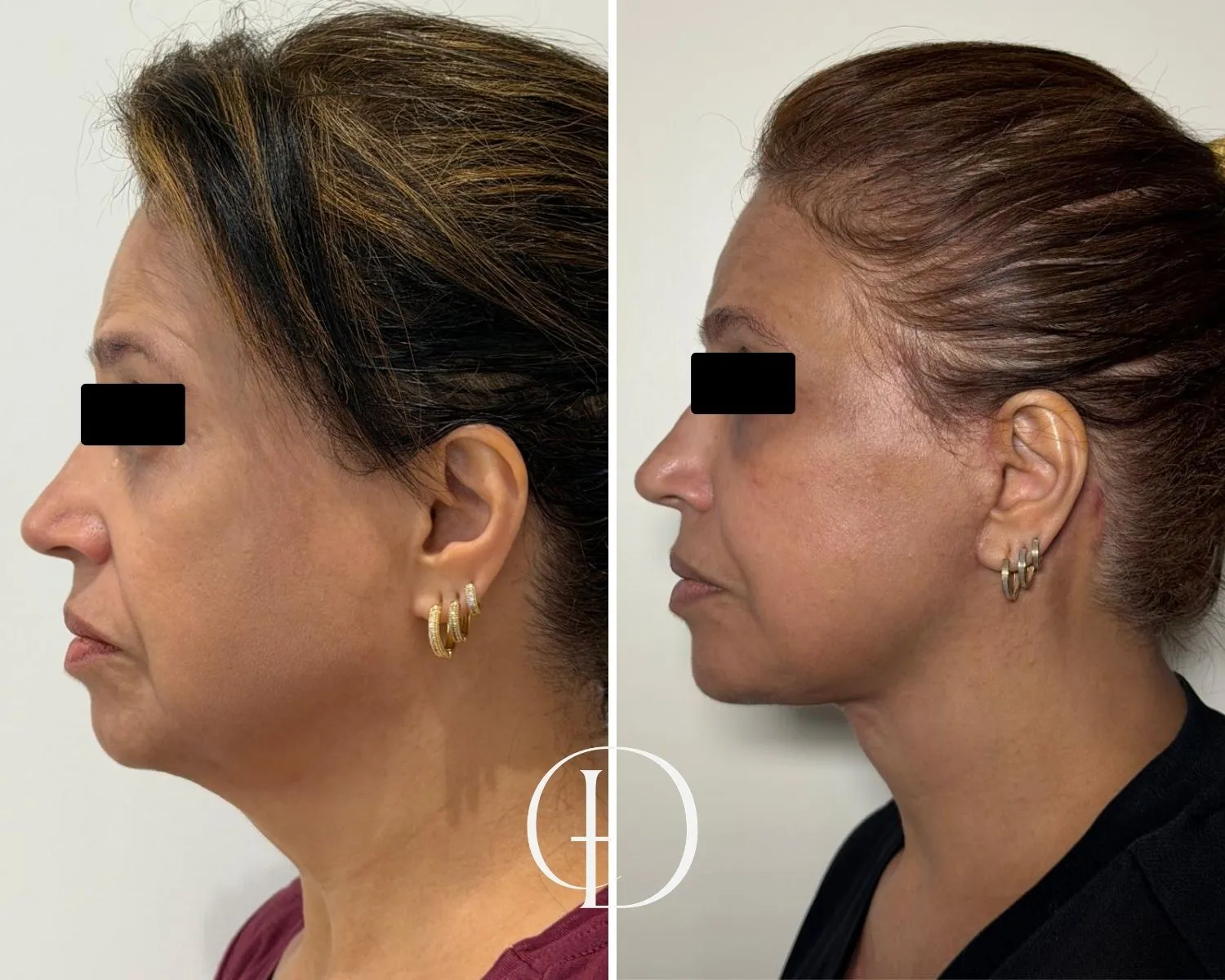 Pós operatório de facelift deep plane 1 ano