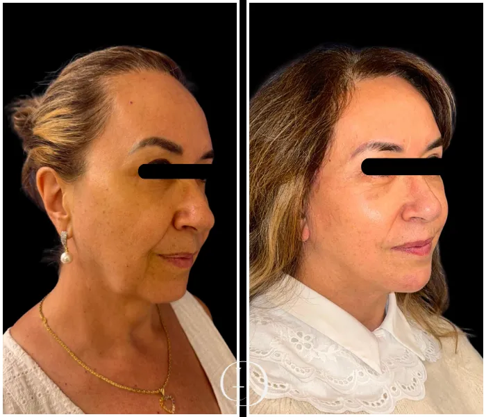 Pós operatório de facelift deep plane