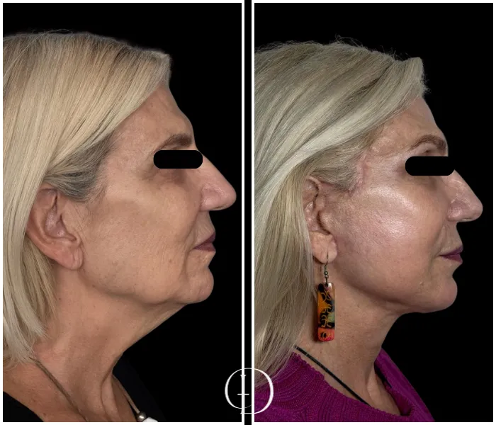 Pós operatório de facelift deep plane 2 meses