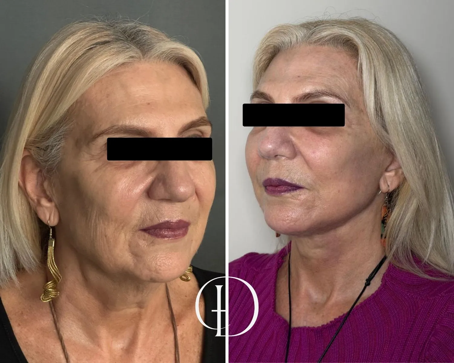 Pós operatório de facelift deep plane 2 meses