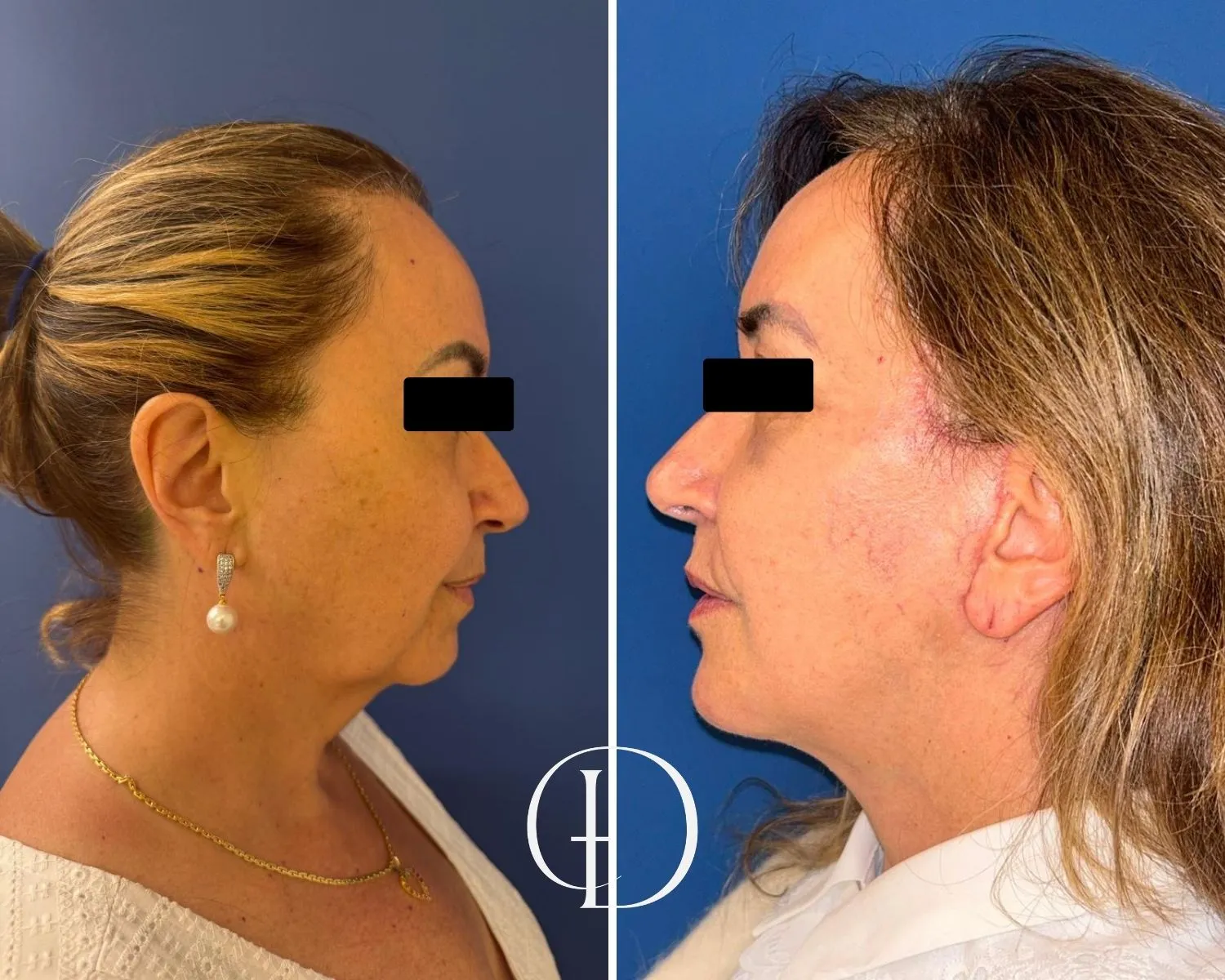 Pós operatório de facelift deep plane