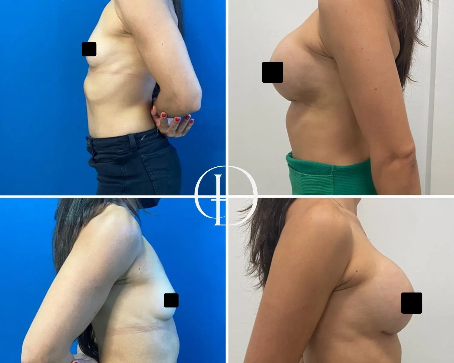 Pós operatório de prótese mamária de aumento