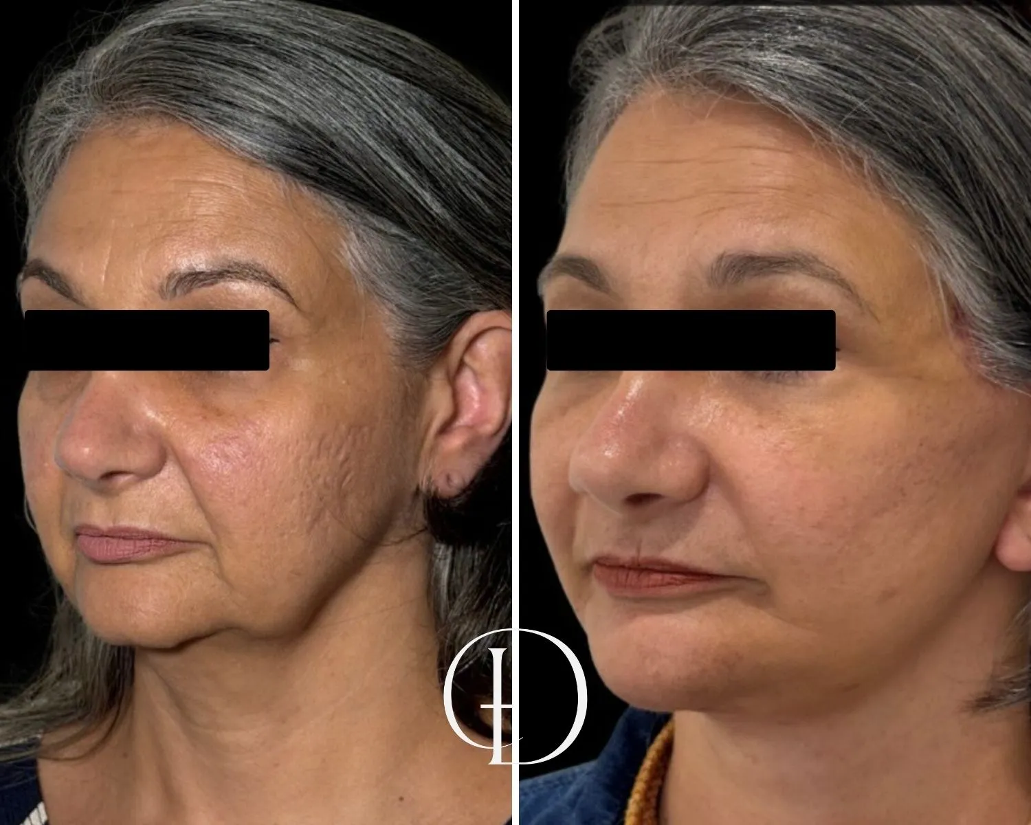Pós operatório facelift- deep plane e deep neck